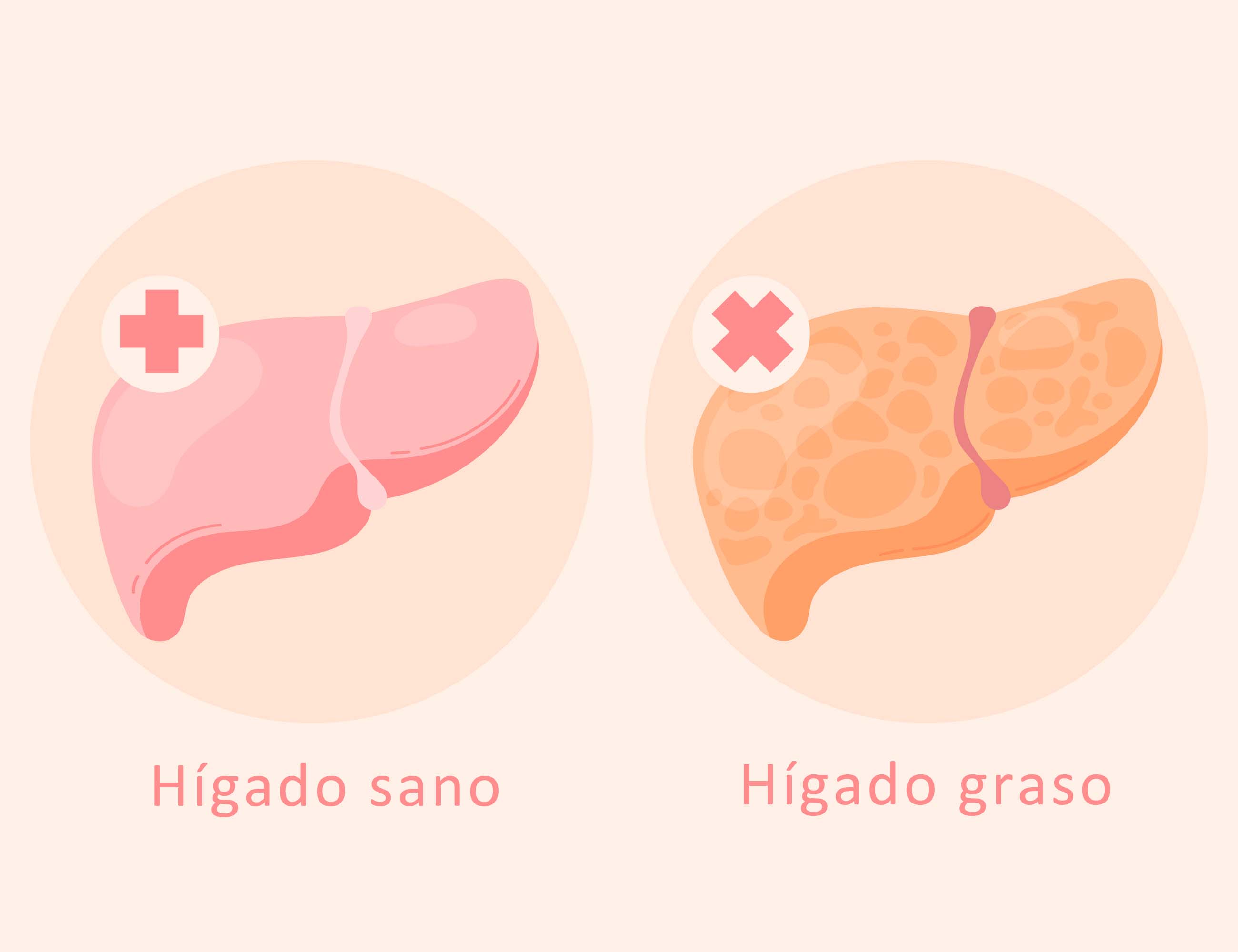 ¿Cómo prevenir el hígado graso?